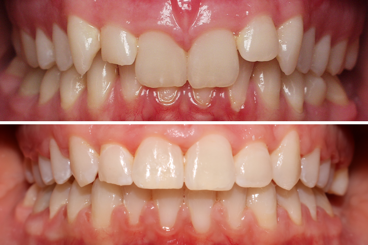 Patient Ah Before After Jpg