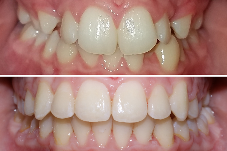 Patient Ellis Before After Jpg