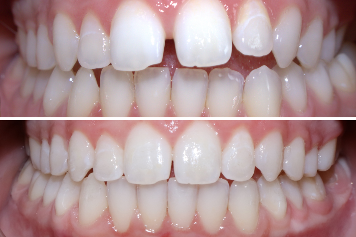 Patient Morgan Before After Jpg